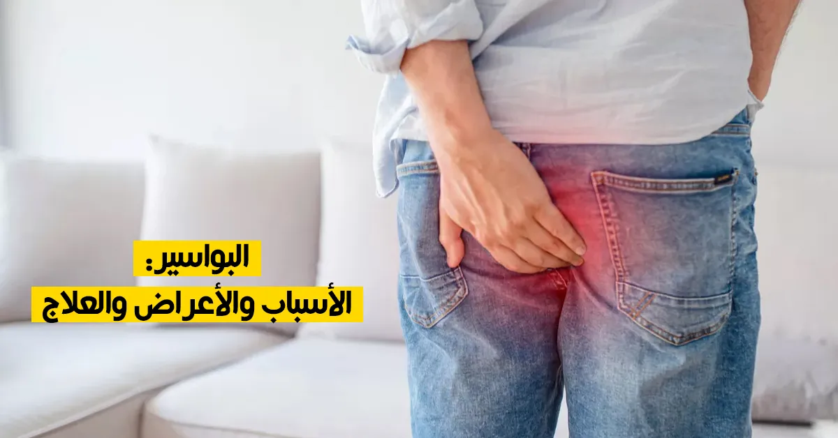 البواسير: الأسباب والأعراض والعلاج